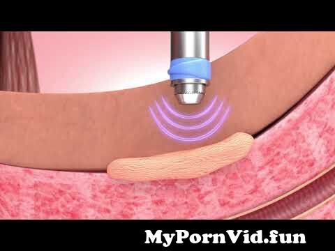 Curved Penis Video