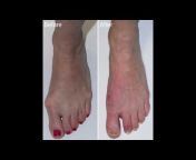 Minimally Invasive Foot Surgery