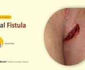 Learn Surgery with us! - Watch complete lecture on sqadia.com nhttps://www.sqadia.com/programs/anal-fistulannStarting from the definition of anal fistula to the explanation of its associated diseases and clinical assessment every detail is covered. Alongside, its diagnosis and three treatment options are comprehensively educated.nn-----nGeneral Surgery Lectures Collection -nhttps://www.sqadia.com/categories/surgery-generaln-----nnAnal fistula is the medical term for an infected tunnel that devel