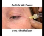 http://www.videoshelf.com/video/dvd/S17D_The_Complete_Guide_to_Dermal_Filler_Injections.htmlnnReverse the effects of aging and achieve the cosmetic effects that clients are seeking. With dermal fillers, you can offer an alternative to invasive surgery and help smooth lines, fill wrinkles, improve volume loss, and correct facial asymmetries. Millions of these procedures are already being performed annually with this increasingly popular cosmetic option for facial rejuvenation.nnIn Aesthetic Video
