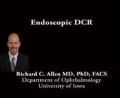 This is Richard Allen at the University of Iowa.This video demonstrates an endoscopic dacryocystorhinotomy (DCR).The endoscope is introduced into the left nares where the middle turbinate and middle meatus are noted.Inferiorly, the inferior turbinate is demonstrated.Inferior to the inferior turbinate resides the inferior meatus where the nasolacrimal duct exits.The upper punctum is dilated with a punctal dilator.A light pipe is placed through the upper punctum and canaliculus to illu