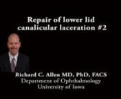 This is Richard Allen at the University of Iowa. This video demonstrates repair of a lower lid canalicular laceration.The patient had a previous attempt at the repair – the previously placed sutures on the skin are noted.The cut end of the canliculus is identified and dilated with the punctal dilator. This will make entrance of the Crawford stent easier. The same dilator is then used to dilate the punctum of the lower lid.In this case a Crawford stent will be placed through the entire sy