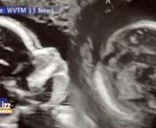 When this mom becomes pregnant with twins, she couldn&#39;t believe her ears when she learned she has 2 wombs!!!!