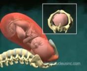 This simplified 3D medical animation depicts a normal vaginal birth using a time-lapse effect. Strong uterine contractions push the fetus (baby) forcibly through the birth canal during labor. Concurrently, a picture-in-picture effect at the upper right shows the baby&#39;s head moving through the mother&#39;s pelvic outlet.