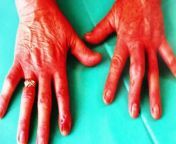 Psoriatic Arthritis, RA, and OA may share some similarities, but they each have their own unique quirks. PsA, for instance, loves to show off with its asymmetric joint inflammation, spine inflammation, and distinct small-joint inflammations in the hands and feet.&#60;br/&#62;On the other hand, RA dives straight into joint issues, bringing along pain, swelling, and stiffness like an uninvited guest crashing the party. And let&#39;s not forget about OA, the seasoned superstar of arthritis, where wear and tear take center stage, causing achy joints and limited movement.&#60;br/&#62;But fear not! We&#39;re here to equip you with the tools to spot the differences. From understanding the telltale signs like dactylitis (sausage-like swelling of fingers or toes) exclusive to PsA, to leveraging medical diagnostics like ultrasonography and serologic tests, we&#39;ve got you covered!