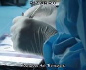 ✨ Let&#39;s look at journeys of hair transplants over 10 years! See real results, real stories, and how you can maintain your mane for the long haul.&#60;br/&#62;&#60;br/&#62;#HairGoals #TransformWithUs #DecadeOfGrowth #SelfEsteemBoost #LookGoodFeelGood