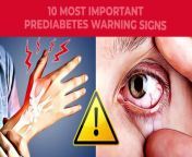 10 Most Important Warning Signs of PREDIABETES You Should Know!&#60;br/&#62;&#60;br/&#62;-----------------------------------------------------------------&#60;br/&#62;&#60;br/&#62;► If you&#39;re looking for a formula that promotes healthy blood sugar levels while offering other health benefits like...&#60;br/&#62;► PROMOTING HEALTHY BLOOD FLOW AND CIRCULATION&#60;br/&#62;► REDUCING SUGAR AND JUNK FOOD CRAVINGS&#60;br/&#62;► SUPPORT FOR DEEP, REJUVENATING SLEEP&#60;br/&#62;&#60;br/&#62;Click on the link below and get to know this fantastic Dietary Supplement:&#60;br/&#62;&#60;br/&#62;► https://bit.ly/3vOR5dl&#60;br/&#62;&#60;br/&#62;---------------------------------------------------------------------&#60;br/&#62;&#60;br/&#62;We want to keep bringing informative research-based videos for you. So if you got value from this video and would like more of it, you can send us a &#39;Super Thanks&#39; by clicking the Thanks button at the bottom of the video. We would greatly appreciate it. Thank you! :)&#60;br/&#62;&#60;br/&#62;---------------------------------------------------------------------&#60;br/&#62;&#60;br/&#62;What is PREDIABETES, and what do you need to know about it?&#60;br/&#62;&#60;br/&#62;1) A yeast infection is typically caused by an overgrowth of the naturally occurring fungus CANDIDA ALBICANS.This can occur due to excess levels of sugar in the bloodstream and urine.Chronic hyperglycemia creates an environment in which this fungus can easily grow and spread. &#60;br/&#62;&#60;br/&#62;2) A Journal of Diabetes Research study found that prediabetic participants had heightened levels of inflammatory markers, like C-reactive protein and interleukin-6.This inflammation can present itself as pain and discomfort in elbows, knees, wrists, and other joints.&#60;br/&#62;&#60;br/&#62;3) Prediabetic individuals are at an increased risk of XEROSIS - or dry skin - compared with those with normal glucose readings. Prediabetes-associated inflammation has also been found to disrupt the protective barrier of the skin, which may also result in skin dryness and an increased risk of skin infections. &#60;br/&#62;&#60;br/&#62;4) Prediabetes is also linked to AUTONOMIC NEUROPATHY – or damage to nerves of internal organs - which may cause GASTROPARESIS and a decrease in gastric motility - meaning the slowing of food through the digestive tract.This can result in feelings of bloating, cramping, constipation, nausea, and other stomach discomfort.&#60;br/&#62;&#60;br/&#62;5) Chronic high blood sugar can damage blood vessels in the retina of the eye.Damage to this light-sensitive tissue can result in a swollen lens and then manifest as blurred vision, or even vision loss.Plus, oxidative stress caused by prediabetes may damage proteins in the lens of the eye, leading to the development of CATARACTS.&#60;br/&#62;&#60;br/&#62;---------------------------------------------------------------------&#60;br/&#62;&#60;br/&#62;Click on the link below and get to know this fantastic Dietary Supplement:&#60;br/&#62;&#60;br/&#62;► https://bit.ly/3vOR5dl