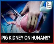 New Jersey woman receives pig kidney, heart pump&#60;br/&#62;&#60;br/&#62;Doctors have transplanted a pig kidney into a New Jersey woman who was near death, part of a dramatic pair of surgeries that also stabilized her failing heart.&#60;br/&#62;&#60;br/&#62;Lisa Pisano’s combination of heart and kidney failure left her too sick to qualify for a traditional transplant, and out of options. Then doctors at NYU Langone Health devised a novel one-two punch: Implant a mechanical pump to keep her heart beating and days later transplant a kidney from a genetically modified pig.&#60;br/&#62;&#60;br/&#62;Pisano is recovering well, the NYU team announced. &#60;br/&#62;&#60;br/&#62;Photos by AP&#60;br/&#62;&#60;br/&#62;Subscribe to The Manila Times Channel - https://tmt.ph/YTSubscribe &#60;br/&#62;Visit our website at https://www.manilatimes.net &#60;br/&#62; &#60;br/&#62;Follow us: &#60;br/&#62;Facebook - https://tmt.ph/facebook &#60;br/&#62;Instagram - https://tmt.ph/instagram &#60;br/&#62;Twitter - https://tmt.ph/twitter &#60;br/&#62;DailyMotion - https://tmt.ph/dailymotion &#60;br/&#62; &#60;br/&#62;Subscribe to our Digital Edition - https://tmt.ph/digital &#60;br/&#62; &#60;br/&#62;Check out our Podcasts: &#60;br/&#62;Spotify - https://tmt.ph/spotify &#60;br/&#62;Apple Podcasts - https://tmt.ph/applepodcasts &#60;br/&#62;Amazon Music - https://tmt.ph/amazonmusic &#60;br/&#62;Deezer: https://tmt.ph/deezer &#60;br/&#62;Tune In: https://tmt.ph/tunein&#60;br/&#62; &#60;br/&#62;#TheManilaTimes &#60;br/&#62;#worldnews &#60;br/&#62;#medical &#60;br/&#62;#implant