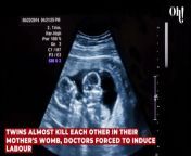 Twins almost kill each other in their mother's womb, doctors forced to induce labour from indian doctor vs pesant